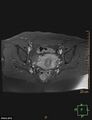 Cesarian scar endometriosis (Radiopaedia 68495-78066 Axial T1 C+ fat sat 15).jpg