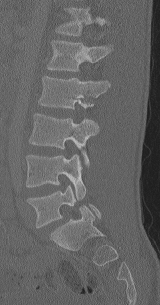 File:Chance fracture (Radiopaedia 40360-42912 Sagittal bone window 40).png