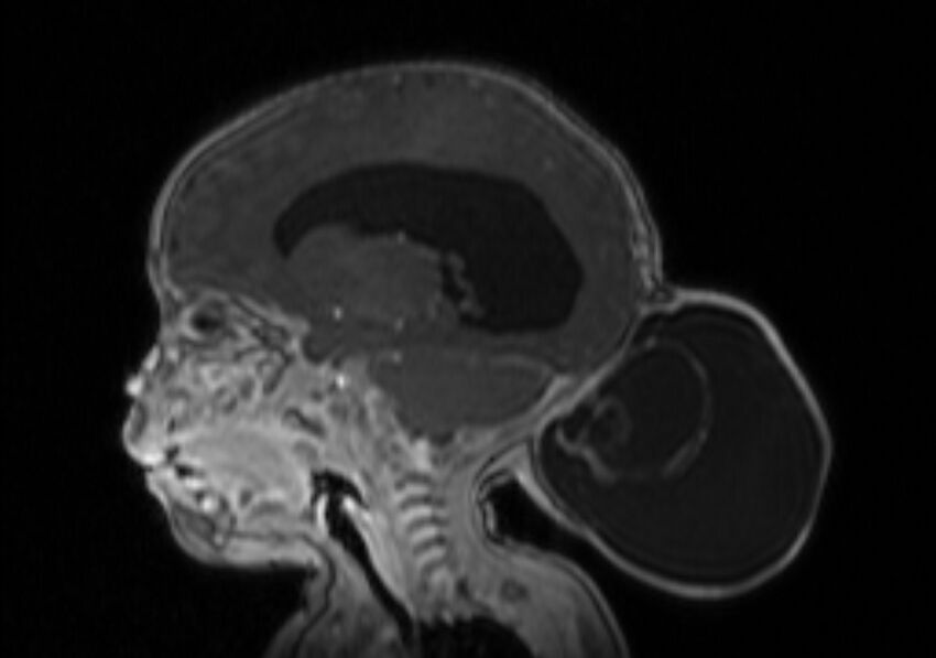 Chiari III malformation with occipital encephalocele (Radiopaedia 79446-92559 Sagittal T1 C+ mpr 30).jpg