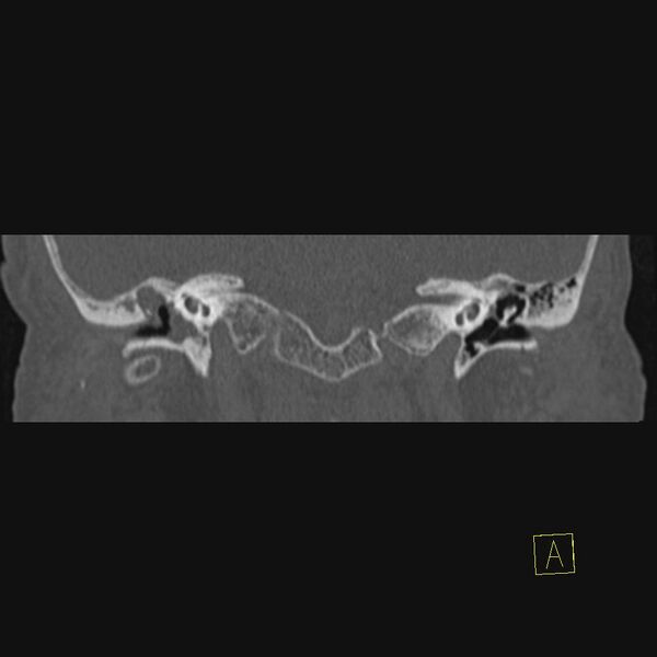 File:Cholesteatomatous chronic otitis (Radiopaedia 14993-14911 Coronal bone window 13).JPEG