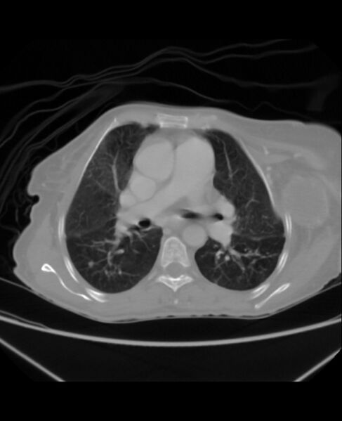 File:Chondrosarcoma (Radiopaedia 79427-92535 Axial lung window 23).jpg