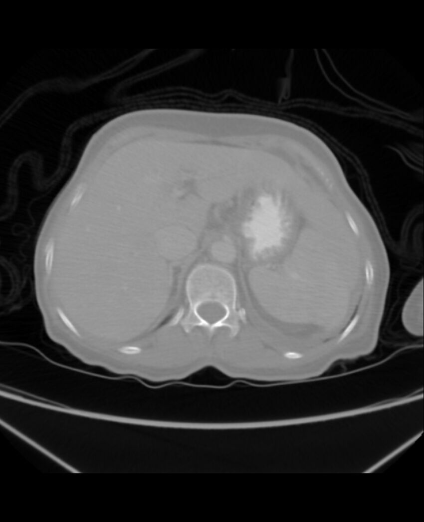 Chondrosarcoma (Radiopaedia 79427-92535 Axial lung window 52).jpg