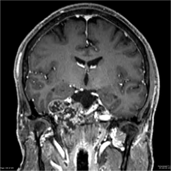 File:Chondrosarcoma of skull base- grade II (Radiopaedia 40948-43654 Coronal T1 C+ 11).jpg