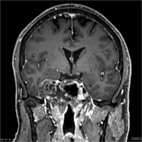 File:Chondrosarcoma of skull base- grade II (Radiopaedia 40948-43654 Coronal T1 C+ 17).jpg
