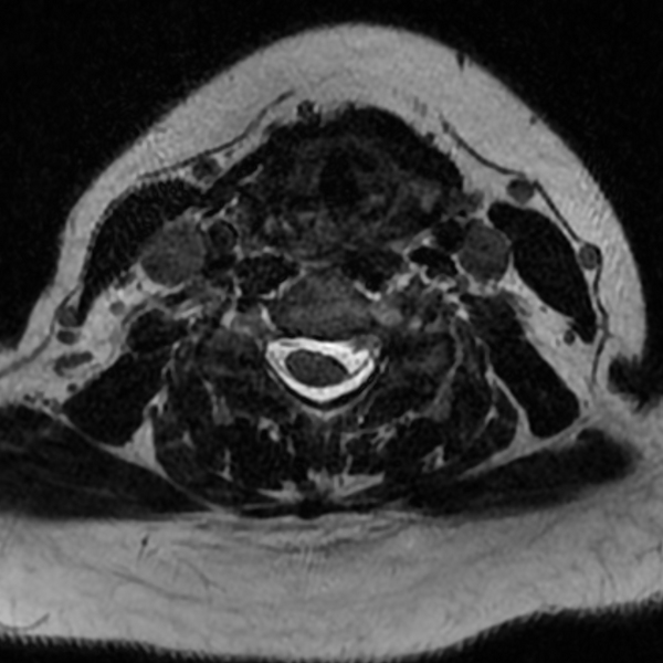 File:Chordoma - cervical spine (Radiopaedia 70084-80111 Axial T2 55).png