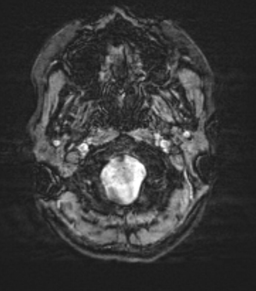 Choroid plexus carcinoma (Radiopaedia 91013-108553 Axial SWI 6).jpg