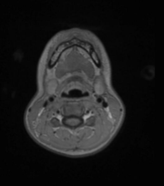 File:Choroid plexus carcinoma (Radiopaedia 91013-108553 Axial T1 C+ 18).jpg