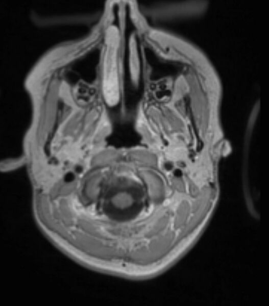 File:Choroid plexus carcinoma (Radiopaedia 91013-108553 Axial T1 C+ 68).jpg