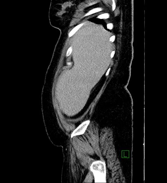 File:Chromophobe renal cell carcinoma (Radiopaedia 84239-99519 G 102).jpg
