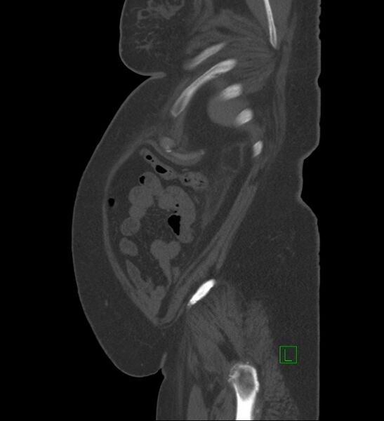 File:Chromophobe renal cell carcinoma (Radiopaedia 84239-99519 Sagittal bone window 12).jpg