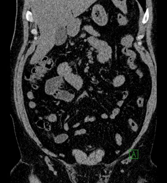 File:Chromophobe renal cell carcinoma (Radiopaedia 84286-99573 Coronal non-contrast 55).jpg