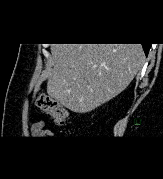 File:Chromophobe renal cell carcinoma (Radiopaedia 84286-99573 F 144).jpg