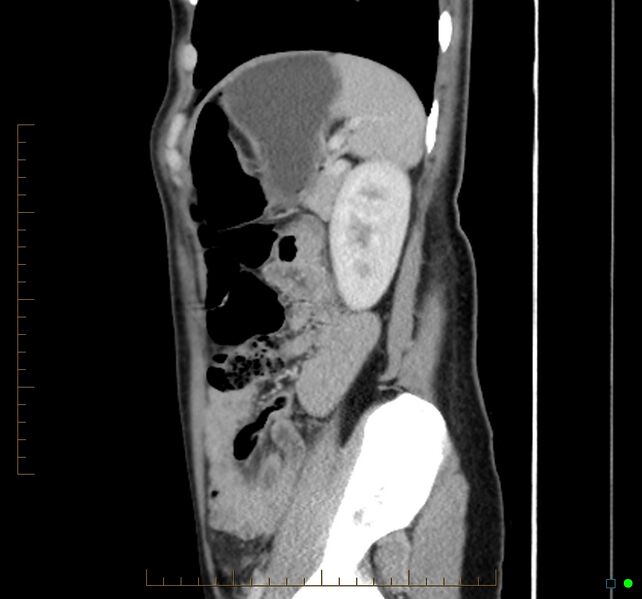 File:Chronic abscess due to "dropped" appendicoliths following appendectomy for perforated appendix (Radiopaedia 58805-66344 D 14).jpg