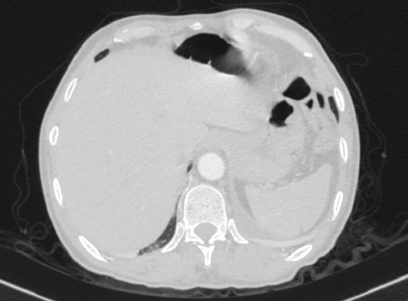 File:Chronic pulmonary embolism with bubbly consolidation (Radiopaedia 91248-108850 Axial lung window 139).jpg