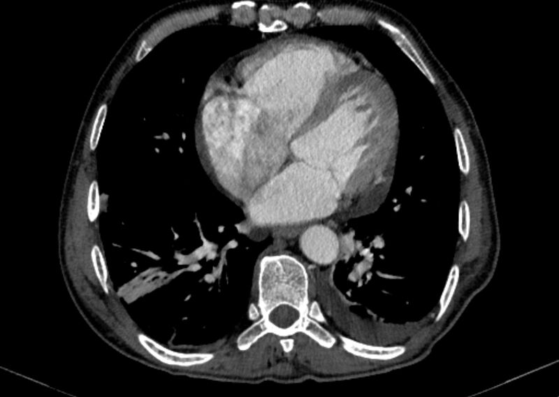 File:Chronic pulmonary embolism with bubbly consolidation (Radiopaedia 91248-108850 C+ arterial phase 102).jpg