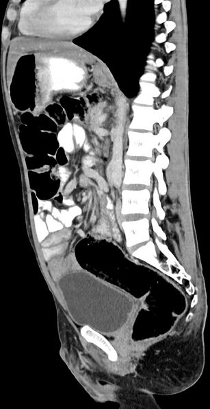File:Chronic small bowel volvulus (Radiopaedia 75224-86322 C 68).jpg
