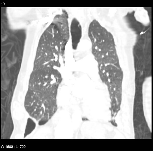 File:Clagett thoracotomy (Radiopaedia 8568-9403 Coronal lung window 19).jpg