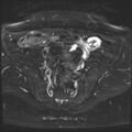 Class II Mullerian duct anomaly- unicornuate uterus with rudimentary horn and non-communicating cavity (Radiopaedia 39441-41755 Axial T2 fat sat 9).jpg