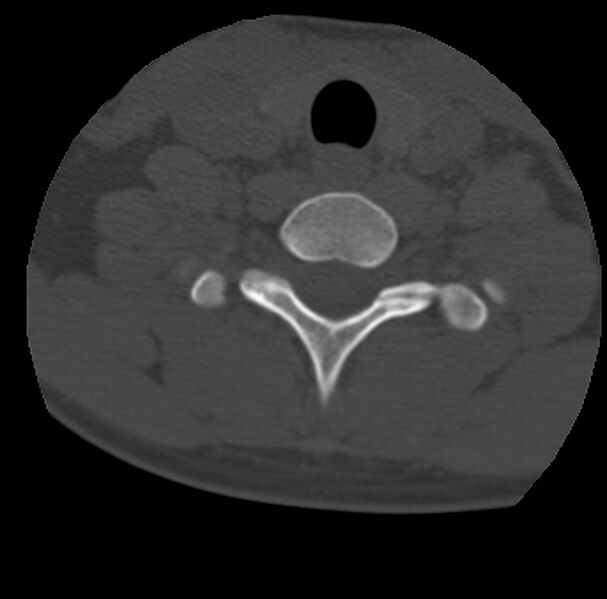 File:Clay-shoveler fracture (Radiopaedia 22568-22590 Axial bone window 62).jpg