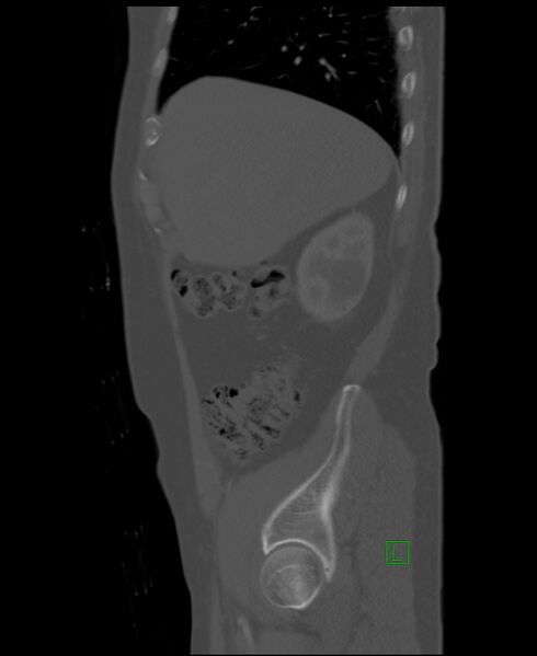 File:Clear cell renal cell carcinoma (Radiopaedia 85006-100539 Sagittal bone window 48).jpg