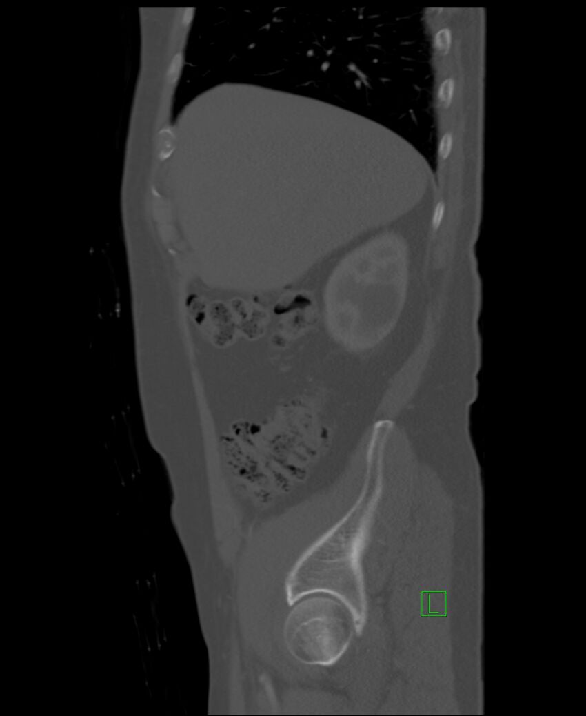 Clear cell renal cell carcinoma (Radiopaedia 85006-100539 Sagittal bone window 48).jpg