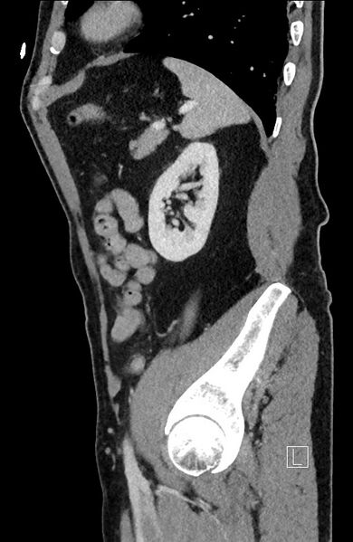 File:Closed loop small bowel obstruction - internal hernia (Radiopaedia 57806-64778 C 31).jpg