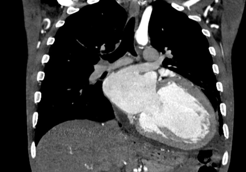 File:Coarctation of aorta with aortic valve stenosis (Radiopaedia 70463-80574 C 125).jpg