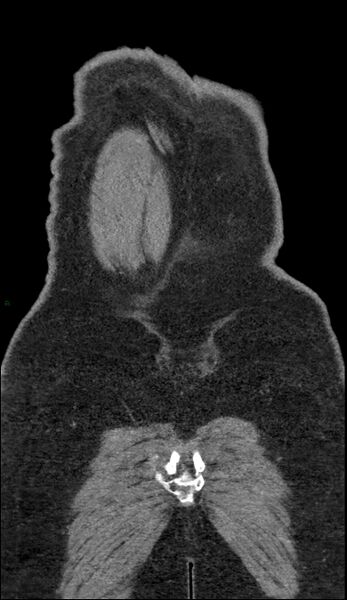 File:Coarctation of the aorta (Radiopaedia 74632-88521 B 258).jpg