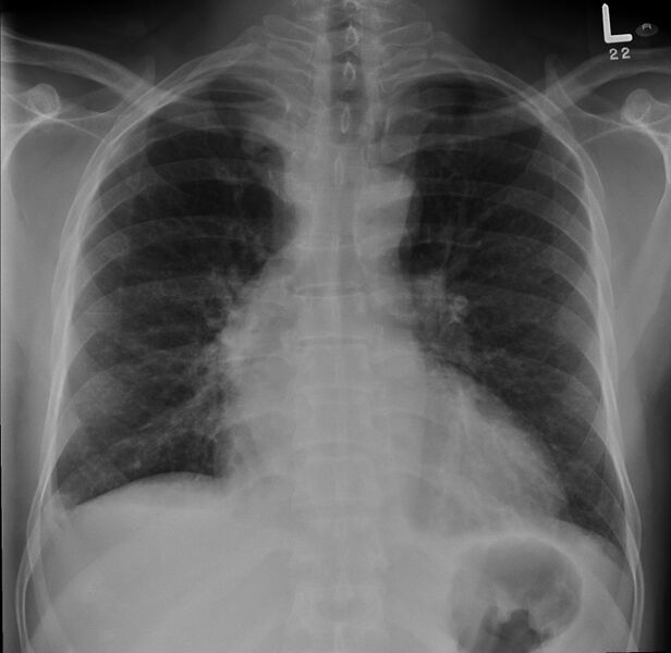 File:Coarctation of the aorta (Radiopaedia 8681-9489 A 1).jpg