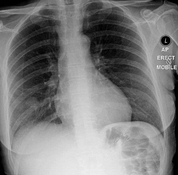 File:Coin lesion - lung adenocarcinoma (Radiopaedia 29787-30307 Frontal 1).png