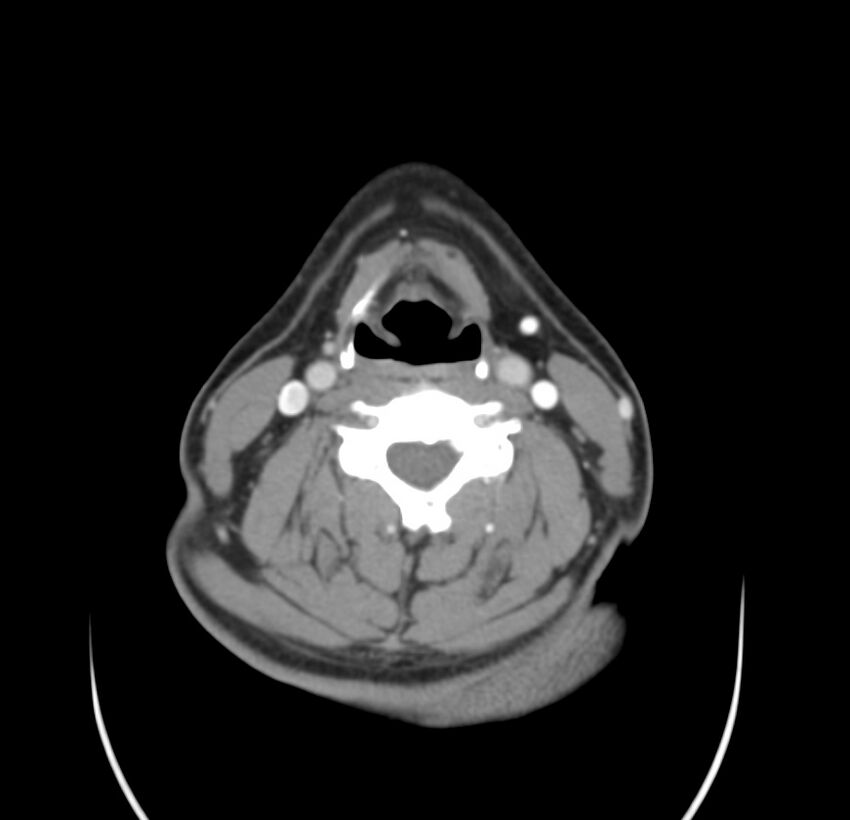 Colloid cyst of thyroid (Radiopaedia 22897-22923 Axial C+ delayed 42).jpg