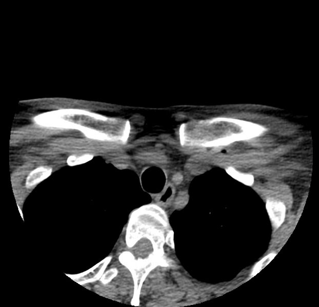 File:Colloid cyst of thyroid (Radiopaedia 22897-22923 Axial non-contrast 53).jpg