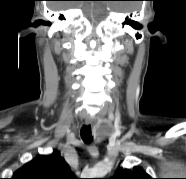 File:Colloid cyst of thyroid (Radiopaedia 22897-22923 Coronal C+ delayed 34).jpg