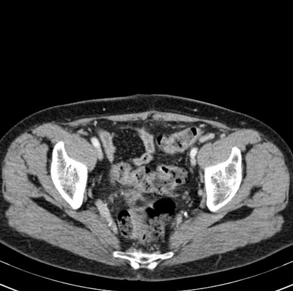File:Colon carcinoma with hepatic metastases (Radiopaedia 29477-29961 A 100).jpg