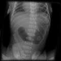 Duodenal atresia (congenital) (Radiopaedia 6352).jpg