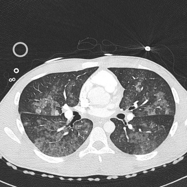 File:Near drowning (pulmonary edema) (Radiopaedia 24685-24958 lung window 27).jpg