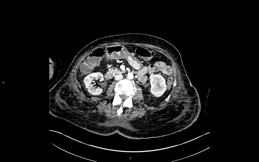 Neo-terminal ileal stricture (Crohn disease) (Radiopaedia 33790-34948 A 195).jpg