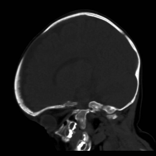 File:Neuroblastoma with skull metastases (Radiopaedia 30326-30958 Sagittal bone window 26).jpg