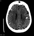 Neurocysticercosis (Radiopaedia 7773-8596 non-contrast 10).jpg