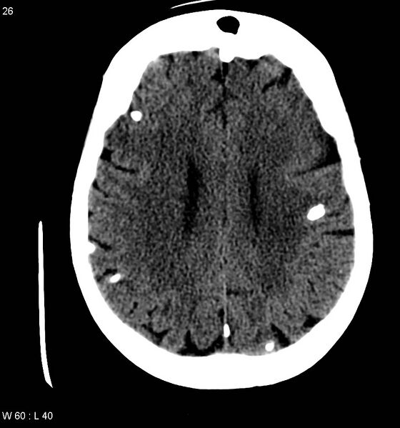 File:Neurocysticercosis (Radiopaedia 7773-8596 non-contrast 10).jpg