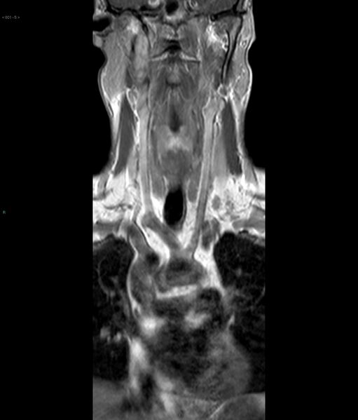 File:Neurofibromatosis type 1 (Radiopaedia 36933-38560 Coronal T1 5).jpg