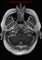 Neuroglial cyst (Radiopaedia 10713-11184 Axial T1 C+ 21).jpg
