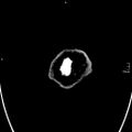 Neurotoxoplasmosis - concentric target sign (Radiopaedia 70644-80783 Axial non-contrast 46).jpg
