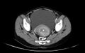 Non-puerperal uterine inversion (Radiopaedia 78343-91094 A 31).jpg