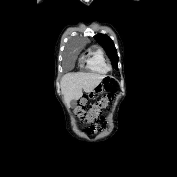 File:Non small-cell lung cancer (Radiopaedia 24467-24769 Coronal C+ delayed 11).jpg