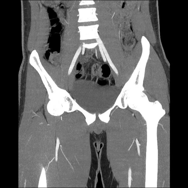 File:Normal CT angiogram of pelvis (Radiopaedia 45390-49430 B 22).jpg
