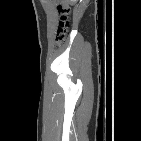 File:Normal CT angiogram of pelvis (Radiopaedia 45390-49430 C 16).jpg
