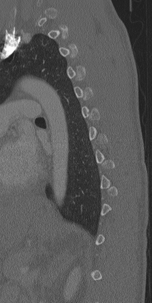 File:Normal CT thoracic spine (Radiopaedia 40181-42688 Sagittal bone window 15).png