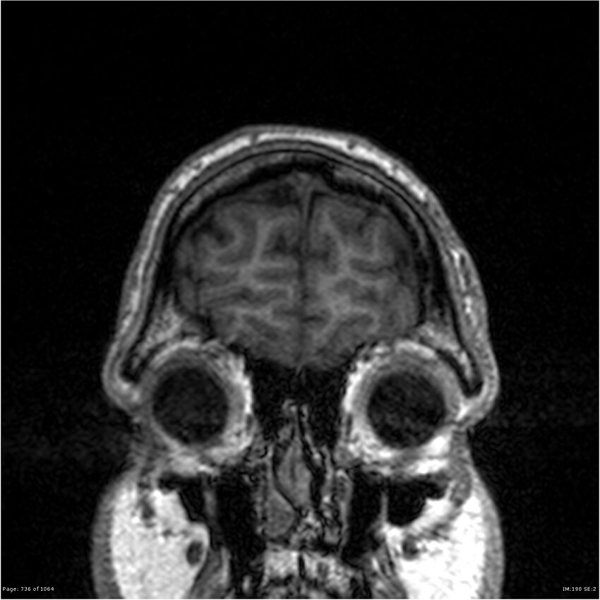 Normal brain MRI (non-focal epilepsy protocol) (Radiopaedia 38571-40700 Coronal T1 94).jpg