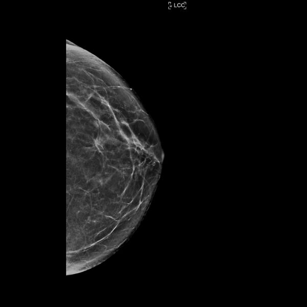 File:Normal breast mammography (tomosynthesis) and ultrasound (Radiopaedia 65325-74353 LCC C-view 1).jpeg